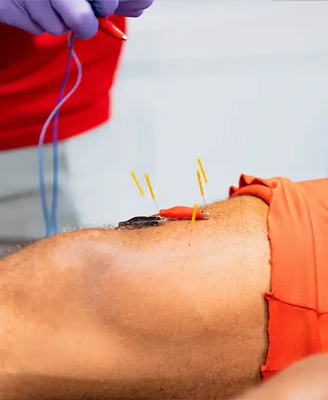 Dry needling session at Kaizen Health and Wellness