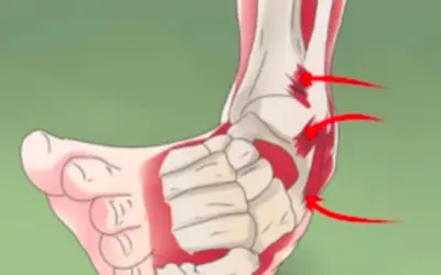 Do I need an X-ray after an ankle sprain?